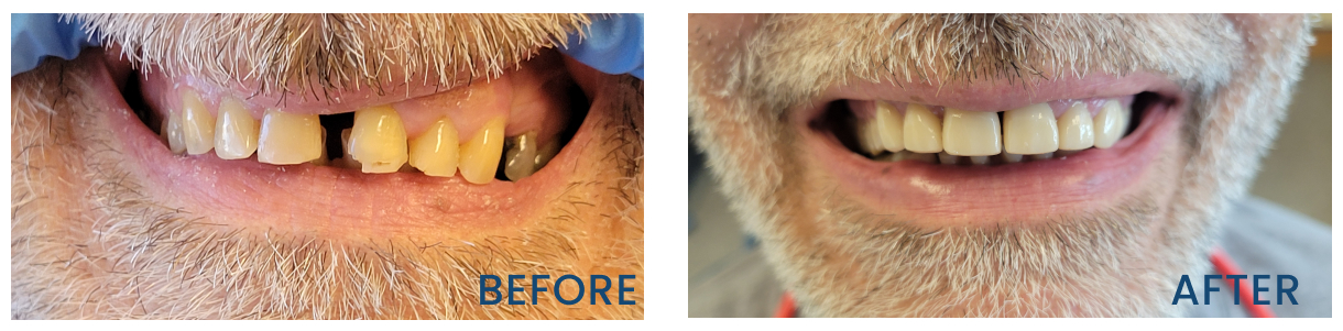 Before and After